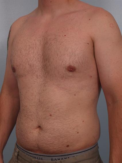 Gynecomastia After Photo Patien 2