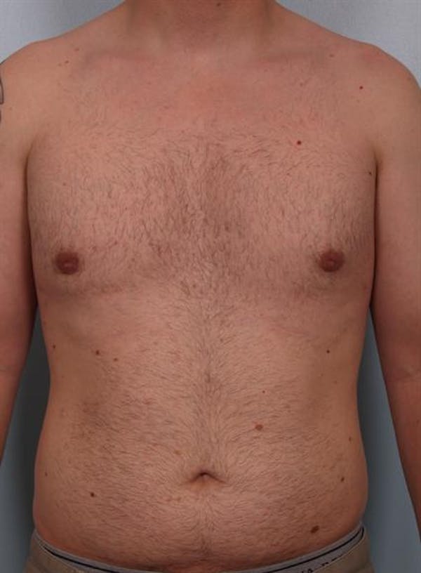 Male Liposuction Before & After Gallery - Patient 1310856 - Image 4
