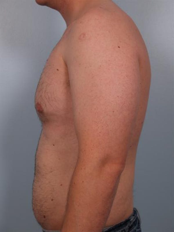 Male Liposuction Before & After Gallery - Patient 1310856 - Image 5
