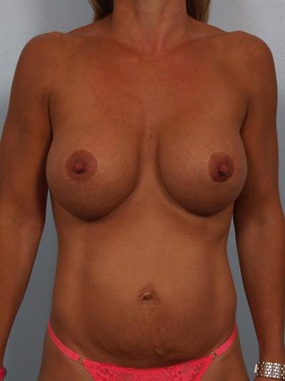 Complex Breast Revision Gallery - Patient 1310858 - Image 2