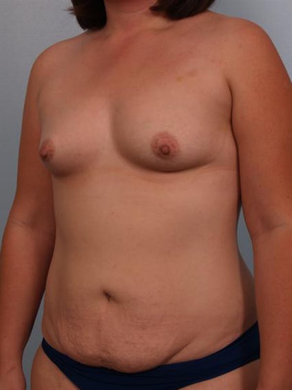 Mommy Makeover Before & After Gallery - Patient 1310860 - Image 3