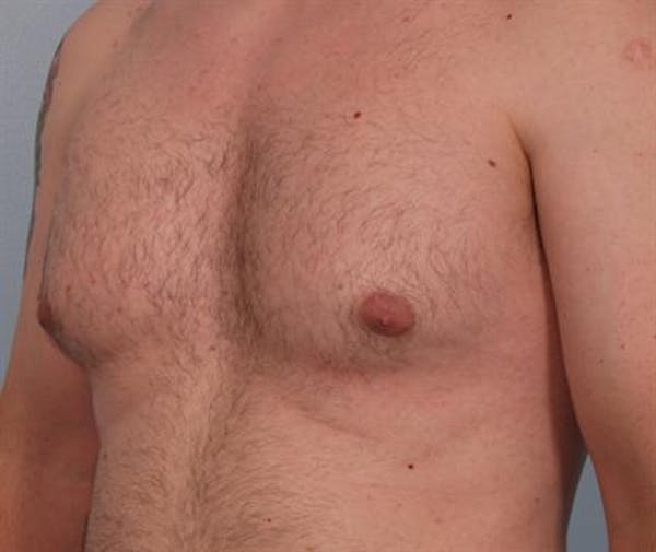 Male Liposuction Before & After Gallery - Patient 1310856 - Image 7