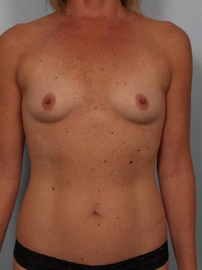 Breast Augmentation Before & After Gallery - Patient 1310863 - Image 1
