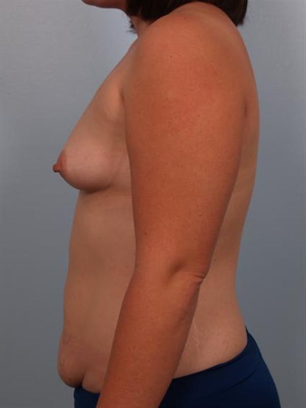 Mommy Makeover Before & After Gallery - Patient 1310860 - Image 5