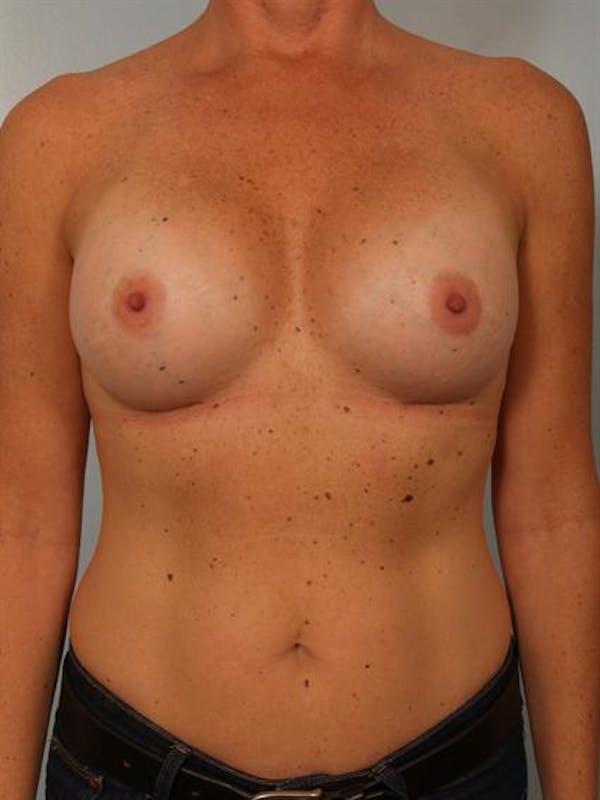 Breast Augmentation Before & After Gallery - Patient 1310863 - Image 2