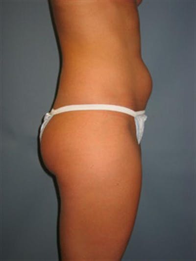 Power Assisted Liposuction Gallery - Patient 1310867 - Image 1