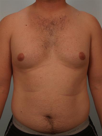 Gynecomastia Before Photo Patient 3