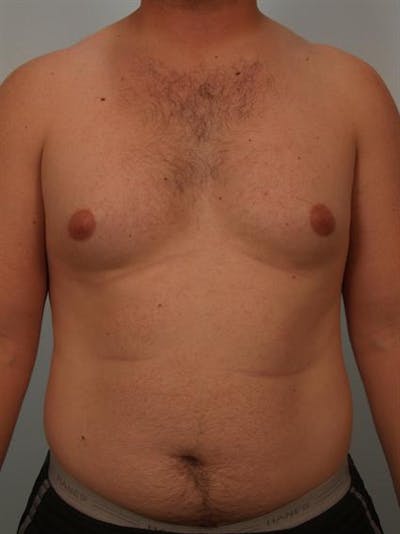 Male Liposuction Before & After Gallery - Patient 1310862 - Image 1