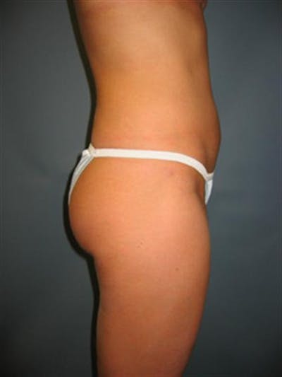 Power Assisted Liposuction Before & After Gallery - Patient 1310867 - Image 2