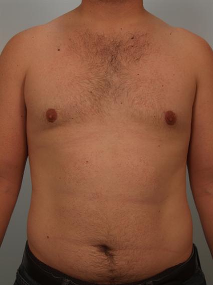 Gynecomastia After Photo Patien 3