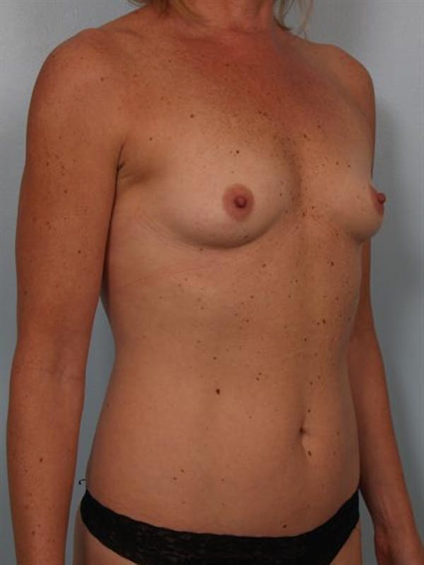 Breast Augmentation Gallery - Patient 1310863 - Image 3