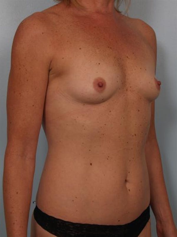 Breast Augmentation Before & After Gallery - Patient 1310863 - Image 3