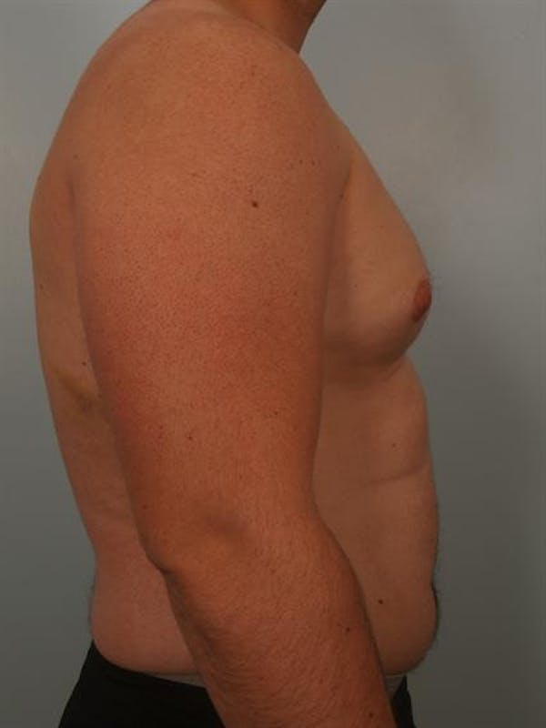 Male Liposuction Before & After Gallery - Patient 1310862 - Image 3