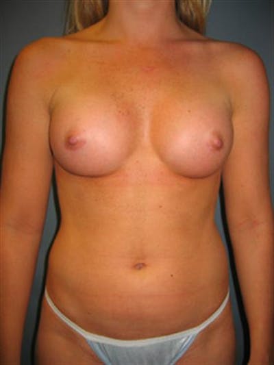 Power Assisted Liposuction Before & After Gallery - Patient 1310867 - Image 4