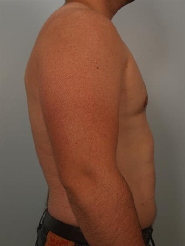 Male Liposuction Before & After Gallery - Patient 1310862 - Image 4
