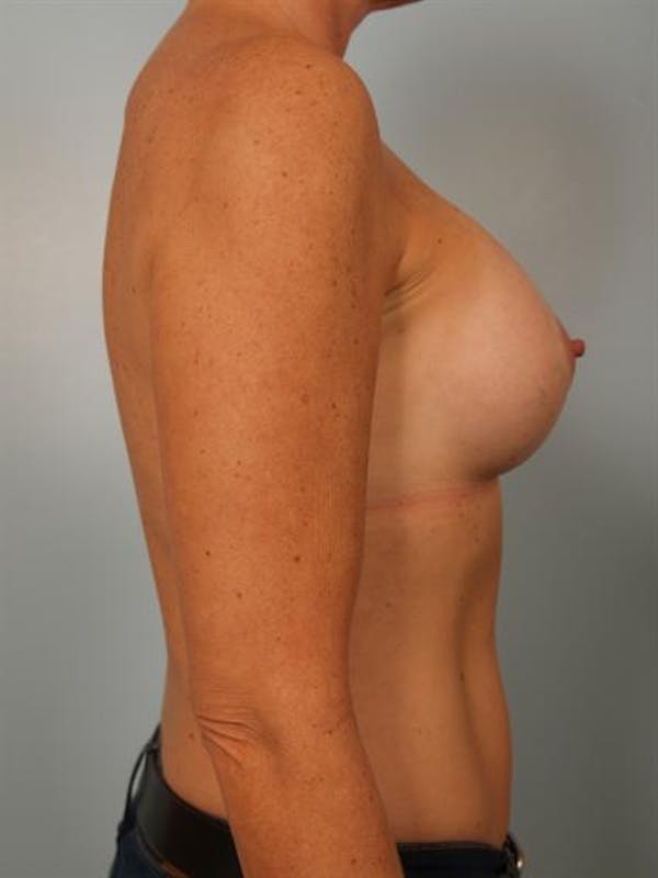 Breast Augmentation Gallery - Patient 1310863 - Image 6