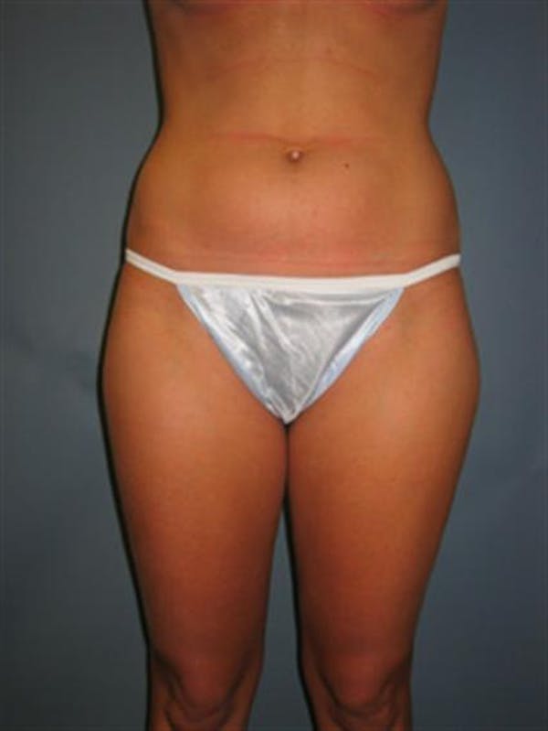 Power Assisted Liposuction Before & After Gallery - Patient 1310867 - Image 5