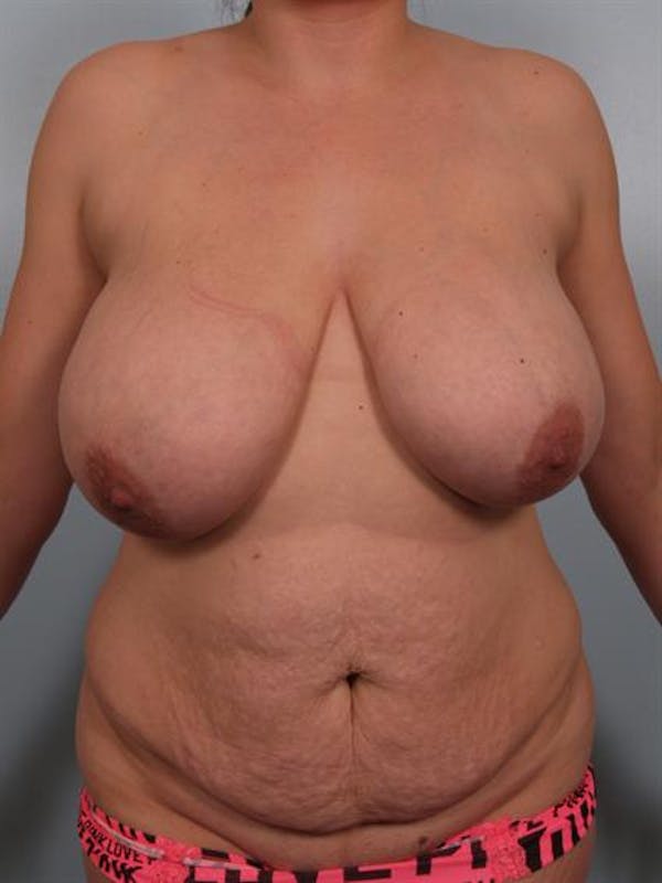 Tummy Tuck Before & After Gallery - Patient 1310866 - Image 1