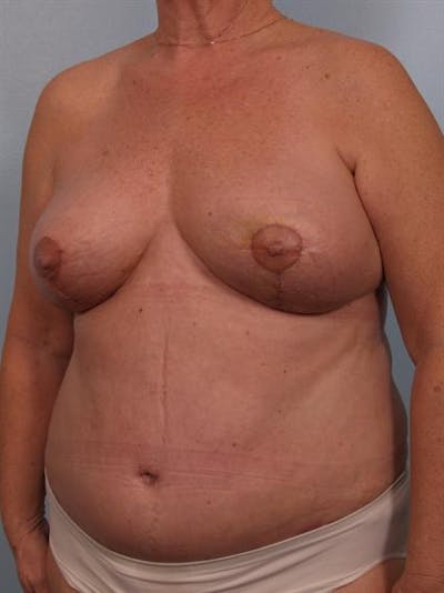 Mommy Makeover Before & After Gallery - Patient 1310865 - Image 4