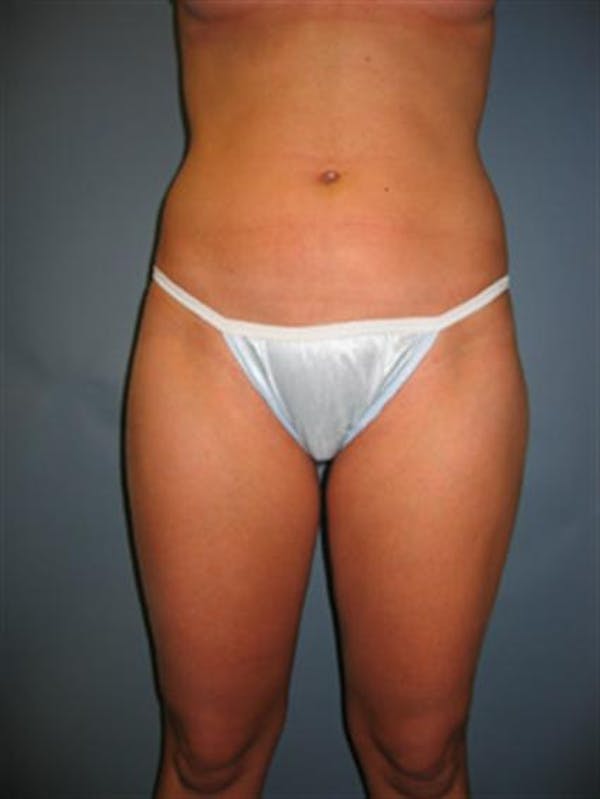 Power Assisted Liposuction Before & After Gallery - Patient 1310867 - Image 6