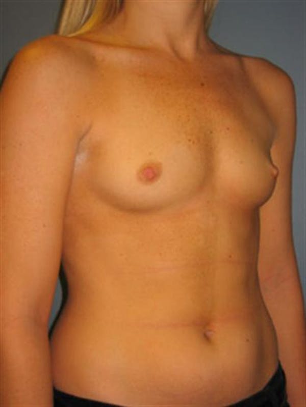 Power Assisted Liposuction Before & After Gallery - Patient 1310867 - Image 7