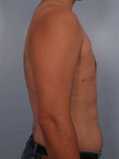 Male Liposuction Before & After Gallery - Patient 1310868 - Image 2