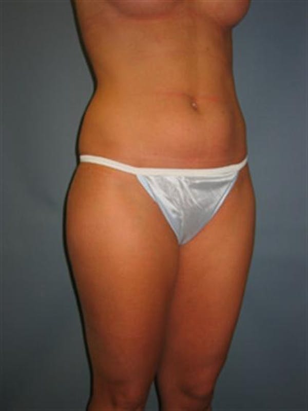 Power Assisted Liposuction Before & After Gallery - Patient 1310867 - Image 9