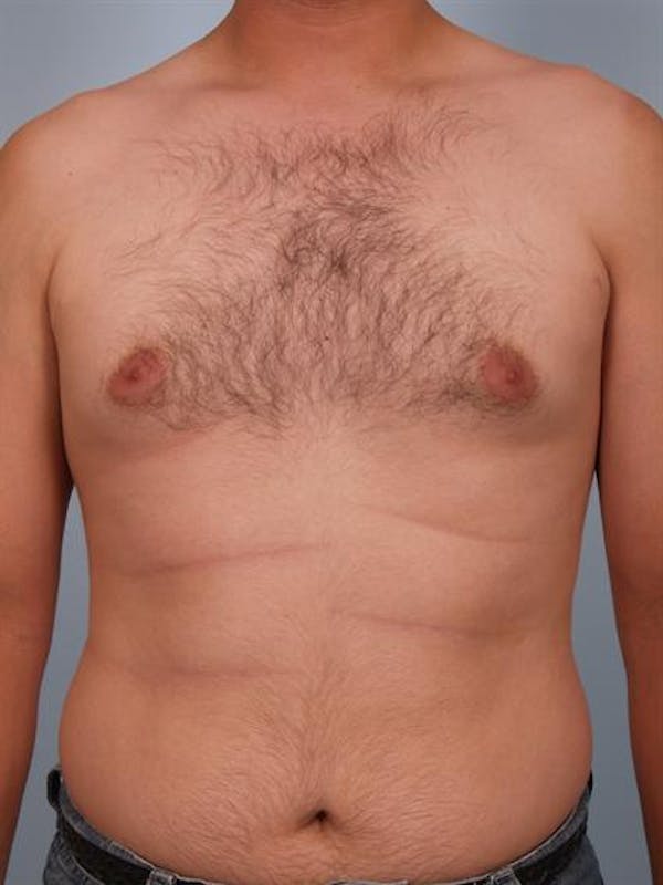 Male Liposuction Before & After Gallery - Patient 1310868 - Image 3