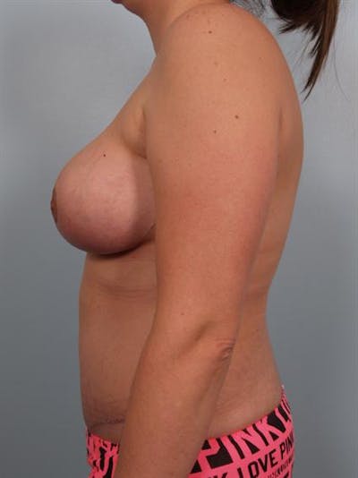 Tummy Tuck Before & After Gallery - Patient 1310866 - Image 6