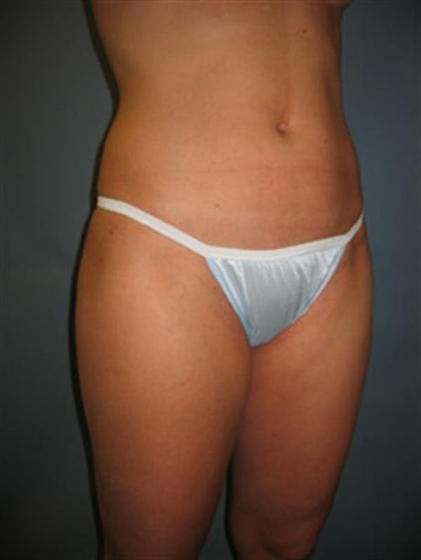 Power Assisted Liposuction Before & After Gallery - Patient 1310867 - Image 10