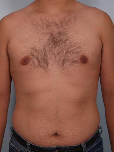 Male Liposuction Before & After Gallery - Patient 1310868 - Image 4