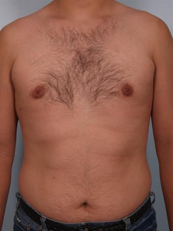 Male Liposuction Gallery - Patient 1310868 - Image 4