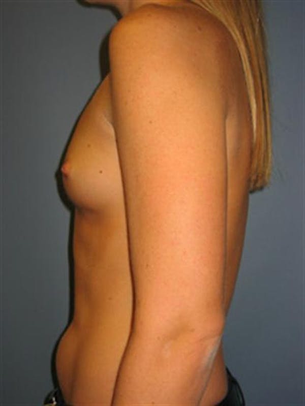 Power Assisted Liposuction Before & After Gallery - Patient 1310867 - Image 11