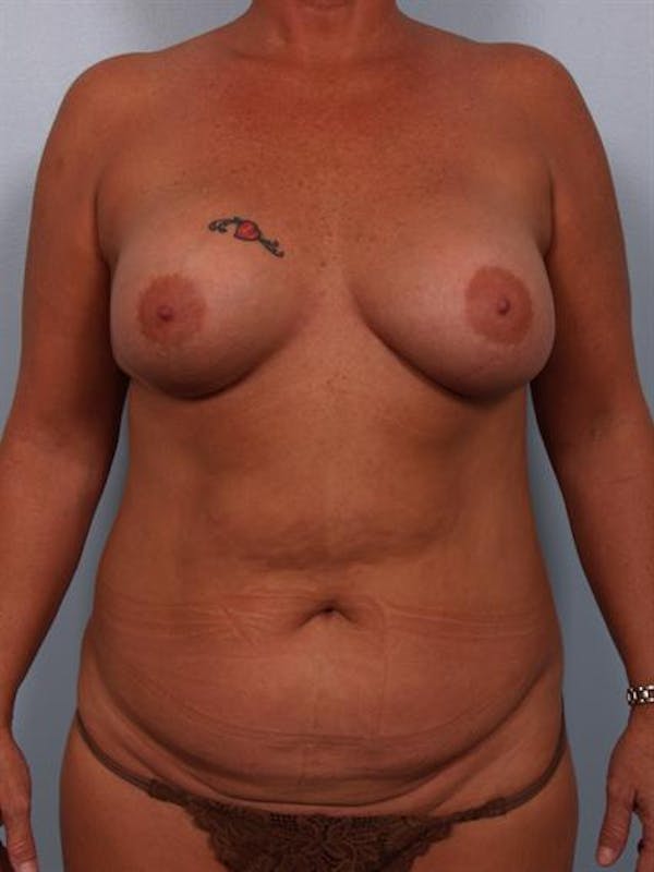 Mommy Makeover Gallery - Patient 1310870 - Image 1