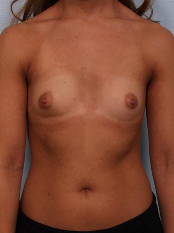 Breast Augmentation Before & After Gallery - Patient 1310869 - Image 5