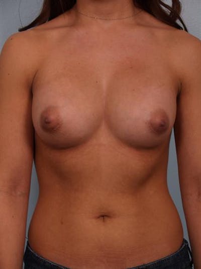 Breast Augmentation Before & After Gallery - Patient 1310869 - Image 6