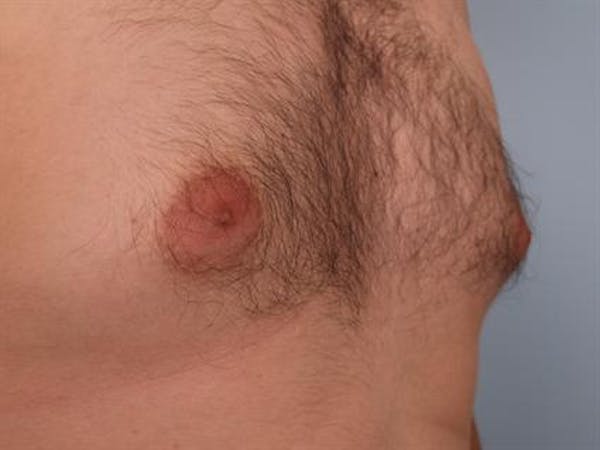 Male Liposuction Before & After Gallery - Patient 1310868 - Image 7