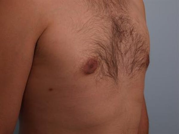 Male Liposuction Gallery - Patient 1310868 - Image 8