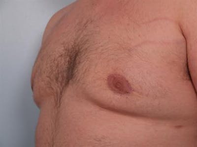 Male Liposuction Before & After Gallery - Patient 1310874 - Image 2