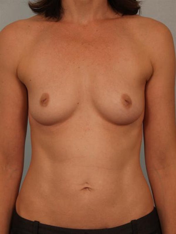 Breast Augmentation Gallery - Patient 1310878 - Image 1
