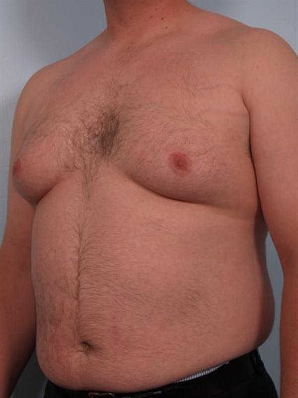 Male Liposuction Gallery - Patient 1310874 - Image 3