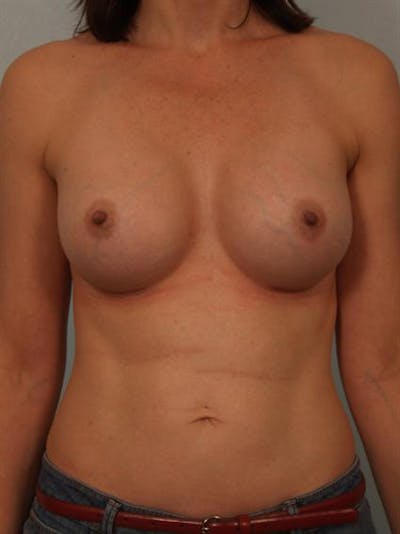 Breast Augmentation Before & After Gallery - Patient 1310878 - Image 2