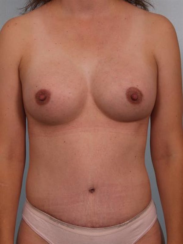 Mommy Makeover Before & After Gallery - Patient 1310876 - Image 2