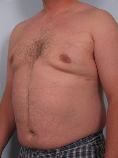 Male Liposuction Before & After Gallery - Patient 1310874 - Image 4