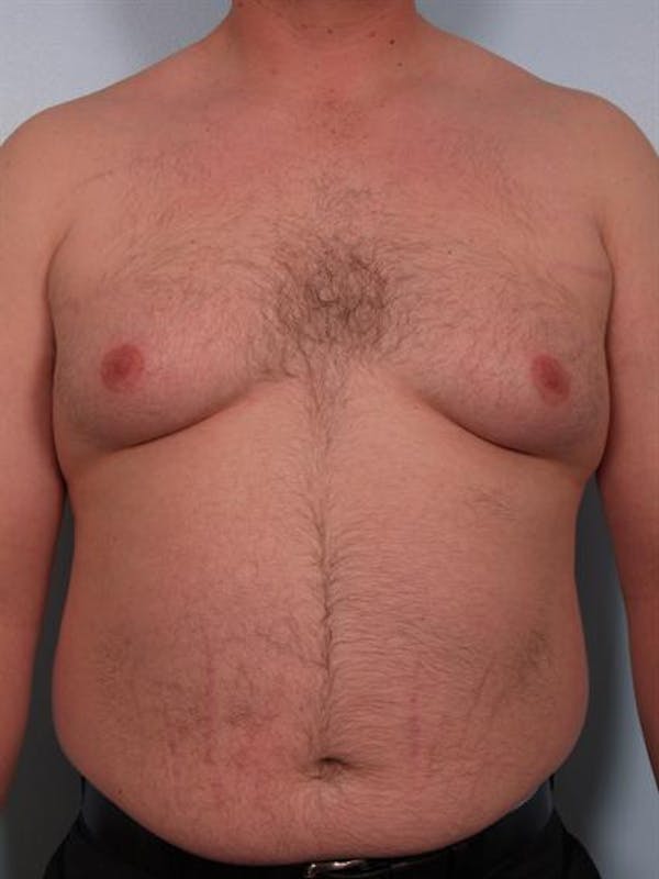Male Liposuction Before & After Gallery - Patient 1310874 - Image 5