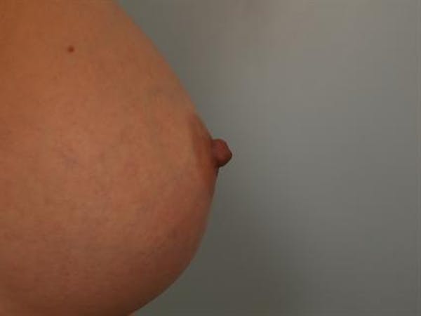 Breast Augmentation Gallery - Patient 1310878 - Image 6
