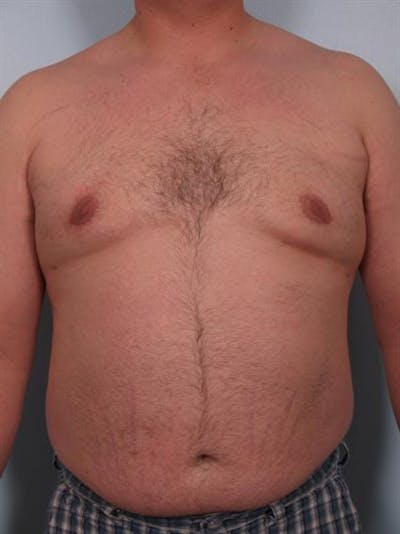 Male Liposuction Before & After Gallery - Patient 1310874 - Image 6