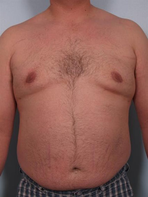 Male Liposuction Gallery - Patient 1310874 - Image 6