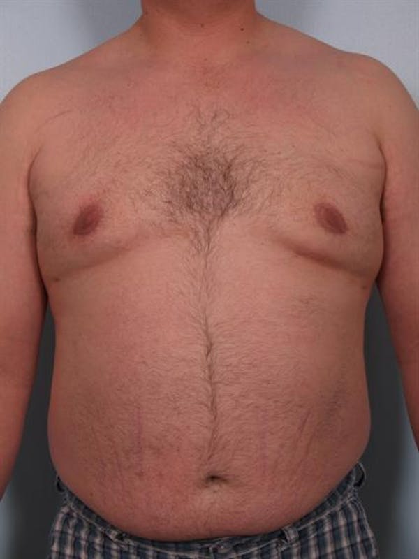 Male Liposuction Before & After Gallery - Patient 1310874 - Image 6