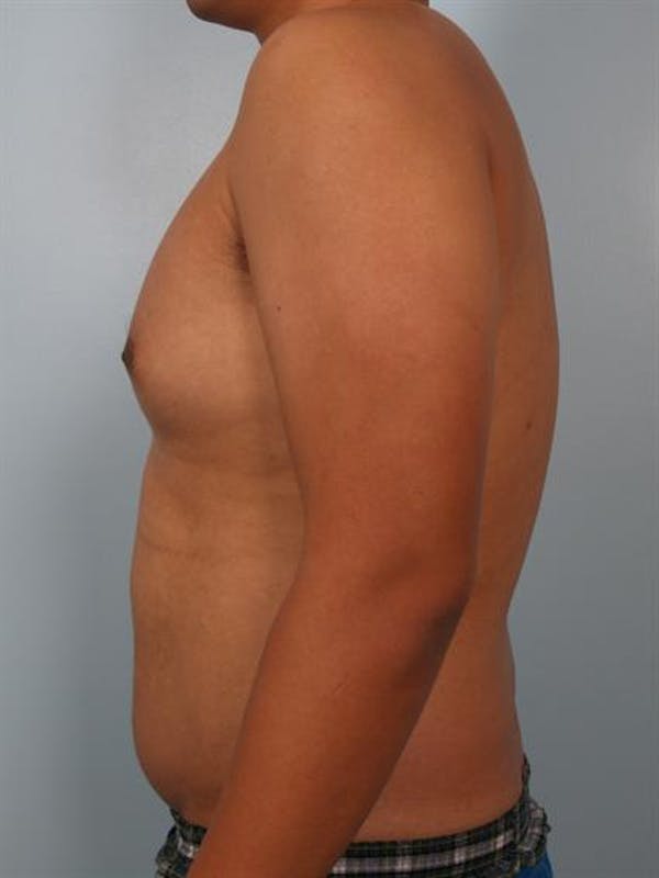 Male Liposuction Before & After Gallery - Patient 1310880 - Image 1